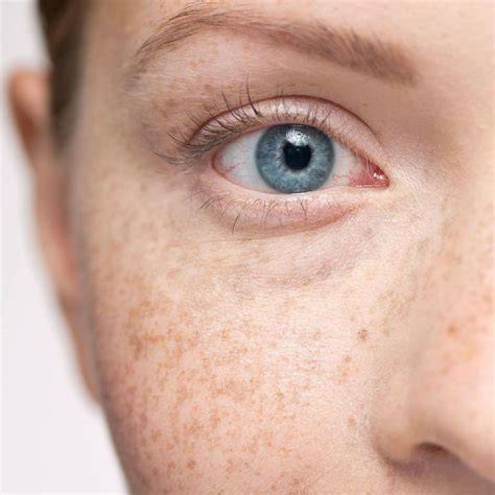 Can eye freckles appear suddenly?