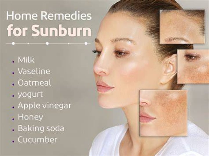 Can honey clear sunburn?
