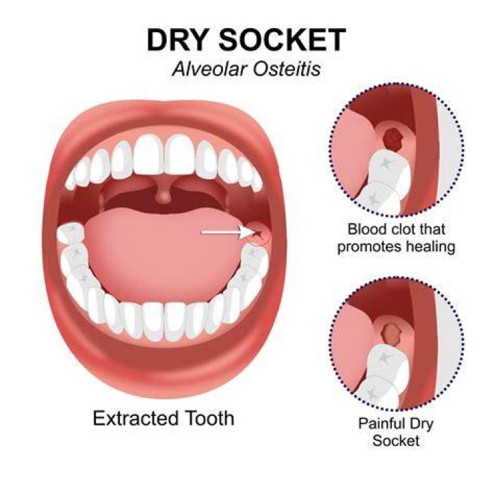 Can you still get dry socket after 10 days?