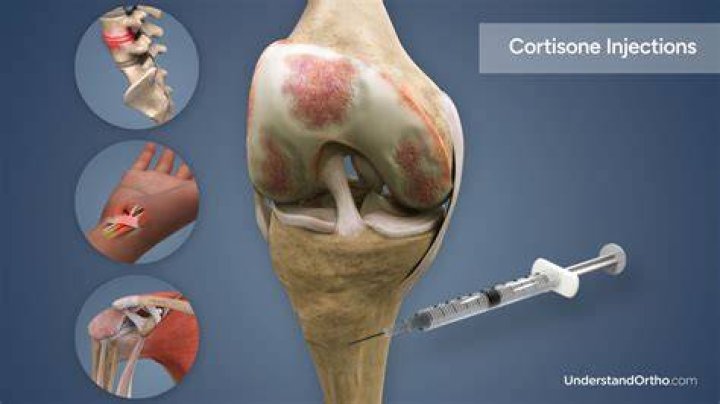 Do cortisone shots help avascular necrosis?