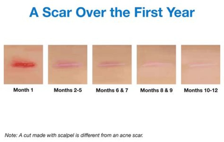 Do scars go away?