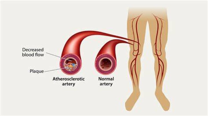 Does walking help clogged arteries?