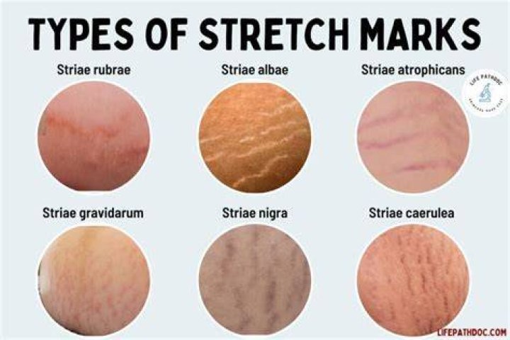 What do new stretch marks look like?