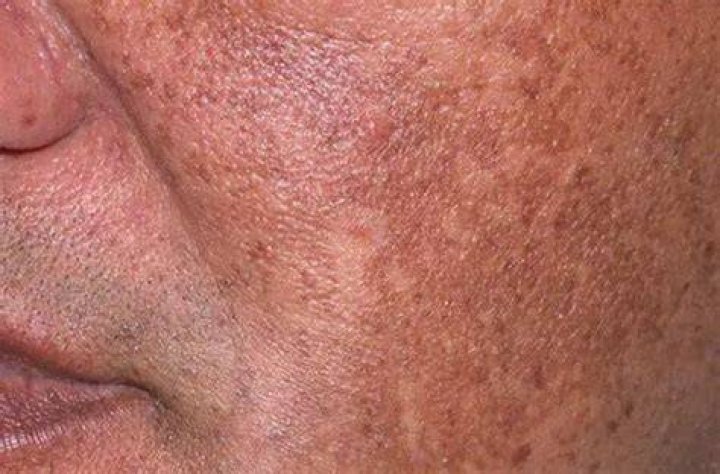 What does hyperpigmentation look like on the face?
