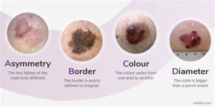 What is considered a small melanoma?